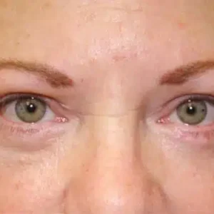 Eyelid Surgery before and after photos