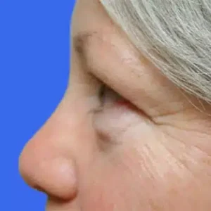 Eyelid Surgery before and after photos