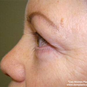 Eyelid Surgery before and after photos