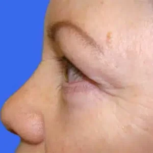 Eyelid Surgery before and after photos