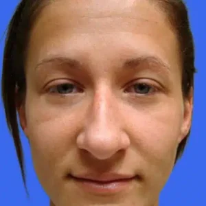 Rhinoplasty before and after photos