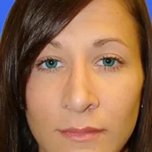 Rhinoplasty before and after photos