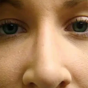 Rhinoplasty before and after photos