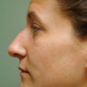 Rhinoplasty before and after photos