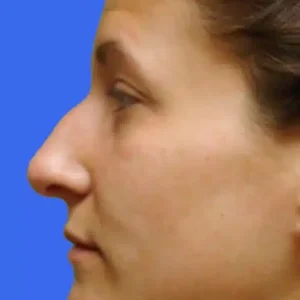 Rhinoplasty before and after photos
