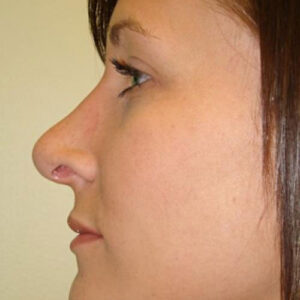 Rhinoplasty before and after photos