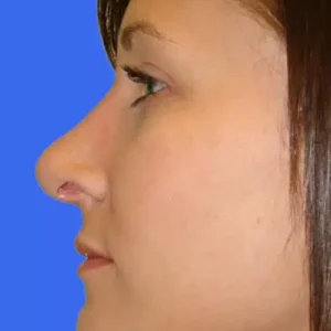 Rhinoplasty before and after photos