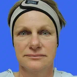 Laser Lift before and after photos