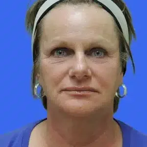 Laser Lift before and after photos