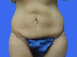 Tummy Tuck before and after photos Tummy Tuck before and after photos