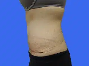 Tummy Tuck before and after photos Tummy Tuck before and after photos