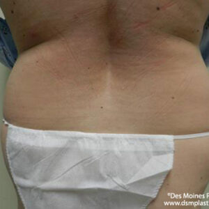 Liposuction before and after photos