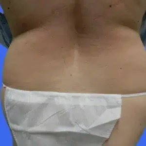 Liposuction before and after photos Liposuction before and after photos