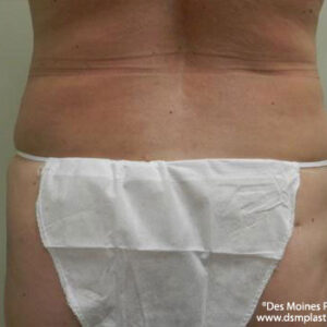 Liposuction before and after photos