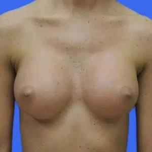 Breast Augmentation before and after photos Breast Augmentation before and after photos