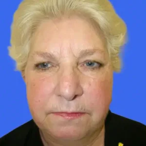 Face Lift before and after photos