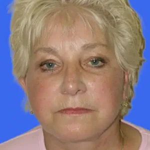 Face Lift before and after photos