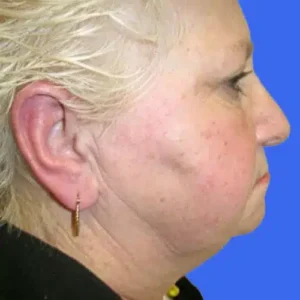 Face Lift before and after photos