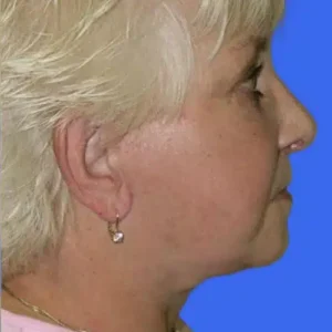 Face Lift before and after photos