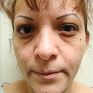 Eyelid Surgery before and after photos