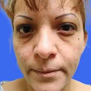 Eyelid Surgery before and after photos
