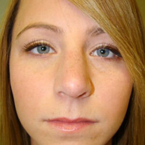 Rhinoplasty before and after photos