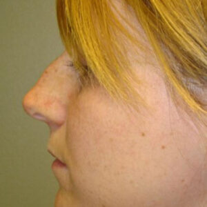 Rhinoplasty before and after photos