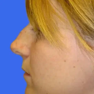 Rhinoplasty before and after photos