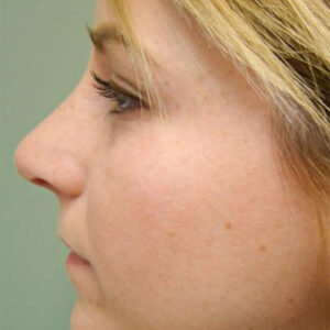 Rhinoplasty before and after photos