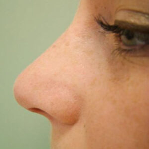 Rhinoplasty before and after photos