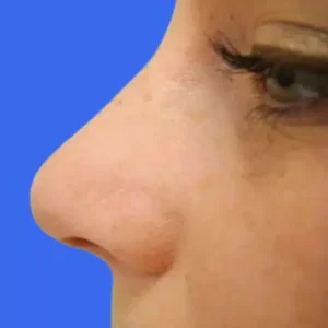 Rhinoplasty before and after photos