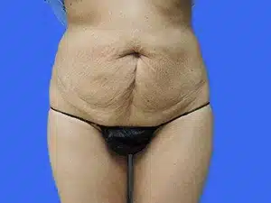 Tummy Tuck before and after photos Tummy Tuck before and after photos