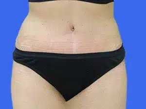 Tummy Tuck before and after photos Tummy Tuck before and after photos
