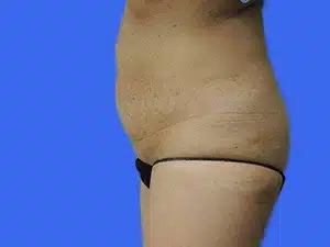 Tummy Tuck before and after photos Tummy Tuck before and after photos