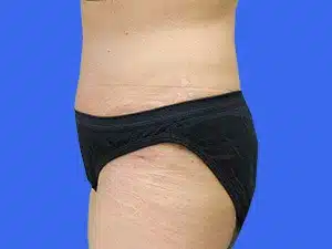 Tummy Tuck before and after photos Tummy Tuck before and after photos