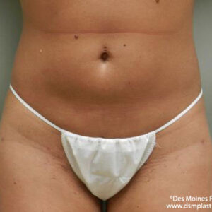 Liposuction before and after photos