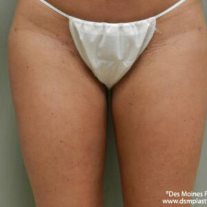 Liposuction before and after photos