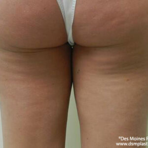 Liposuction before and after photos