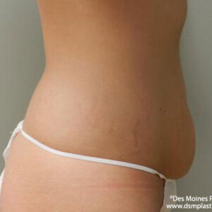 Liposuction before and after photos