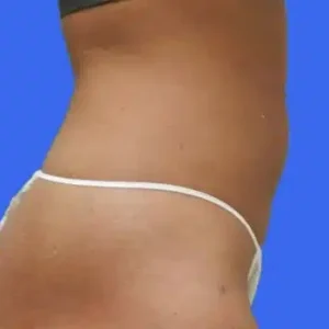 Liposuction before and after photos Liposuction before and after photos