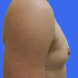 Breast Augmentation before and after photos Breast Augmentation before and after photos