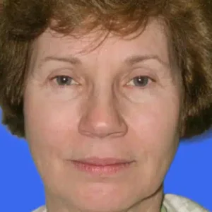 Face Lift before and after photos