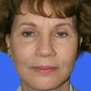 Face Lift before and after photos