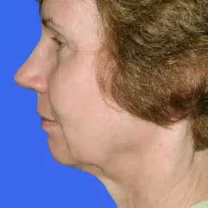 Face Lift before and after photos