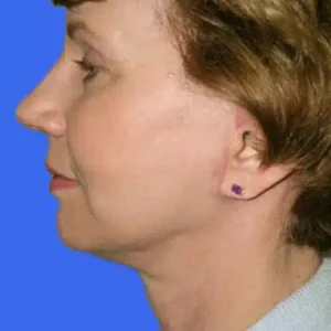 Face Lift before and after photos