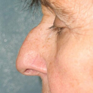 Rhinoplasty before and after photos