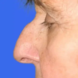 Rhinoplasty before and after photos