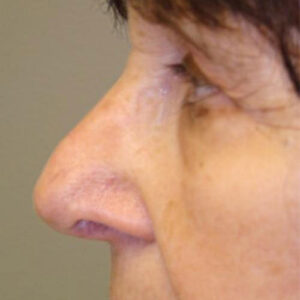 Rhinoplasty before and after photos