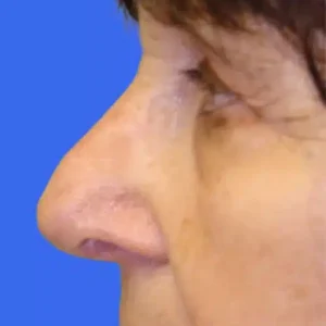 Rhinoplasty before and after photos