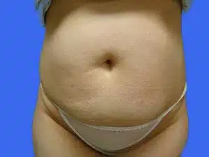 Tummy Tuck before and after photos Tummy Tuck before and after photos
